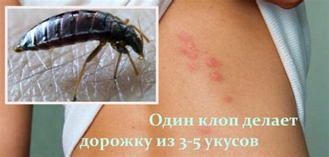 Как кусают клопы домашние: фото и видео с научными пояснениями