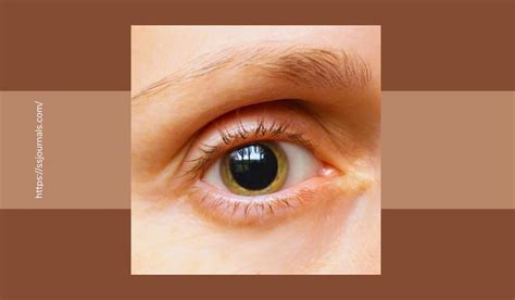 What Is Mydriasis? Discover The Symptoms, Causes, And Treatments