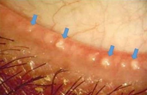 The Demodex mite: What is it | Área Oftalmológica Avanzada