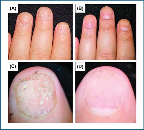 Psoriatic nails treated with fractional CO 2 laser-assisted delivery of ...