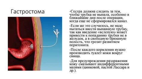 Уход за гастростомой, алгоритм