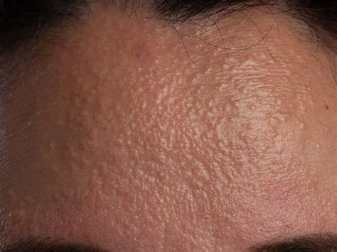 how to get rid of pearly papules 3
