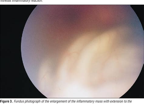 Figure 1 from Sclerosing inflammatory pseudotumor of the eye ...