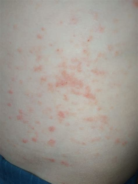 По фото определить что за сыпь на теле