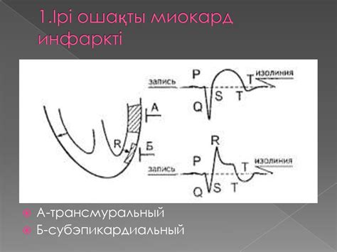 Миокард инфаркті ЭКГ белгілері - презентация онлайн