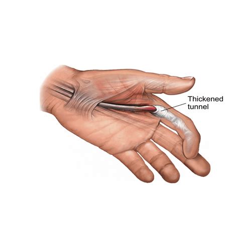 Flexor Pulley System of the Fingers