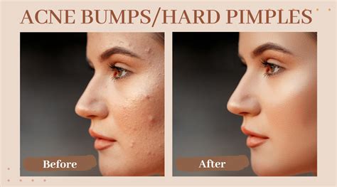 Pimple Like Bumps On Face