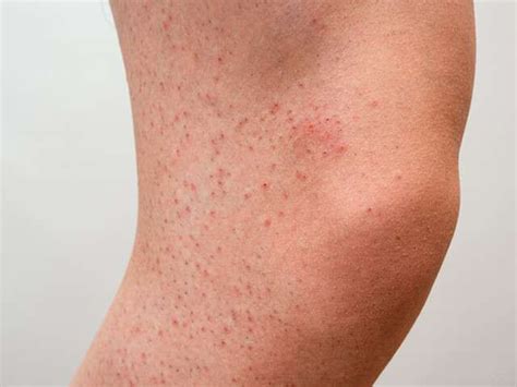 Red Spots on Legs | Femina.in | Red spots on legs, Bumps on legs, Spots ...