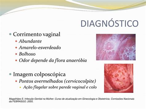 Vulvite E Vulvovaginite - PPT - VULVOVAGINITES PowerPoint Presentation, free download - ID:4274079