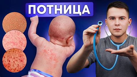 Потница у грудничков: Виды, причины и правильное лечение - YouTube