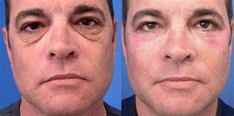 laser skin resurfacing skinspirations expert esthetics
