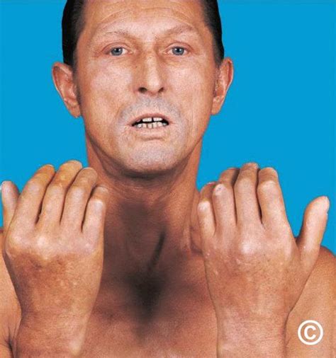 Systemic sclerosis