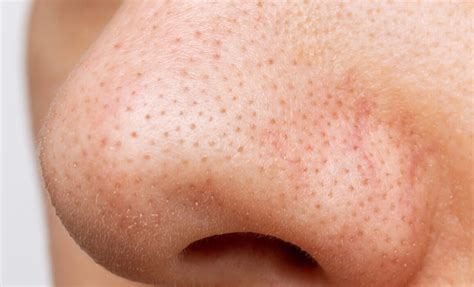 enlarged pores treatments facial pore treatments dr yusra