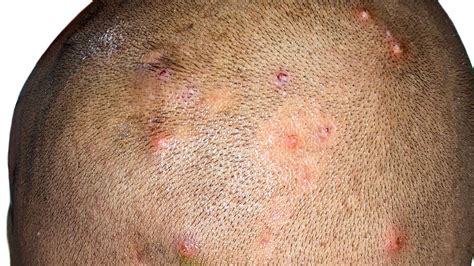 Folliculitis Scalp