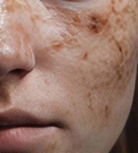 Collagen-Biom — Alfabiom