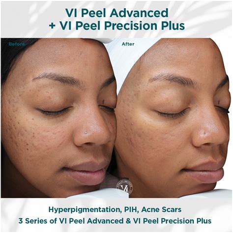 VI Peel Before & After Photos | Women First, LLC