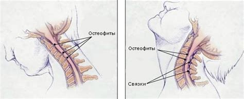 Остеофиты шейного отдела позвоночника: лечение, причины
