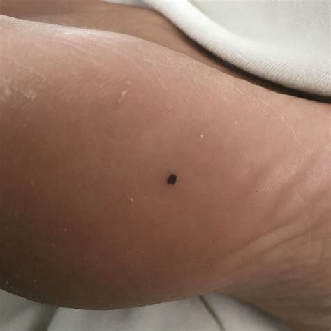 Thoughts on this dark brown spot on heel of foot? : r/Melanoma