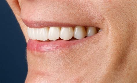 Smile Makeover London - Wimpole Street Dental Clinic