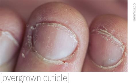 Dry Cuticle Treatment, Tips, and Home Recipe