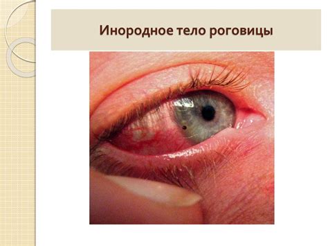 Повреждения органа зрения. Травма - online presentation