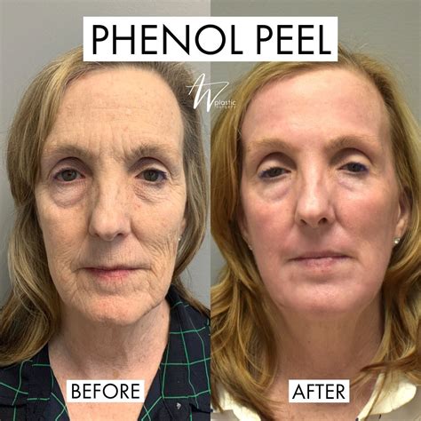 Phenol Peels: What to Know About the Controversial Treatment — See ...