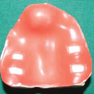 steps  appliance fabrication  primary wax impression  primary