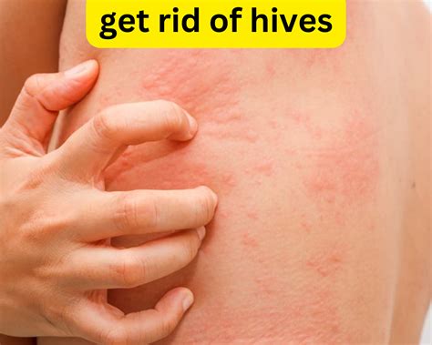 How to get rid of hives