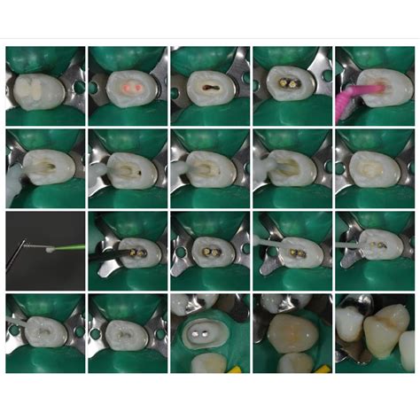 visalys core white ml optident specialist dental products  courses