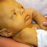 A child with galactosemia... | Download Scientific Diagram