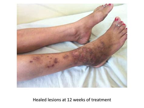 SUBCUTANEOUS AND FUNGAL INFECTIONS | PPTX