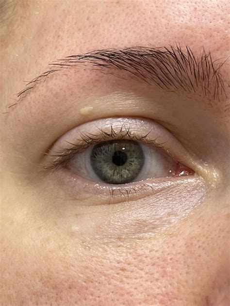 What is this bump on my eyelid? I’ve had it for years and I don’t think ...