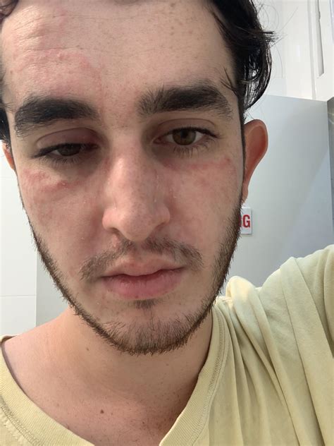 I posted yesterday about red blotches on my face and it’s a lot worse