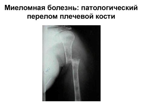 Миеломная болезнь (множественная миелома, болезнь Рустицкого-Калера ...