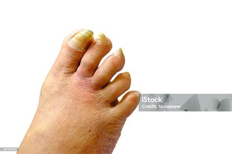 Uñas Enfermas Enfermizas Al Pie De Un Hombre Foto de stock y más banco ...