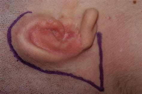 ear reconstruction   flap   retroauricular sulcus journal