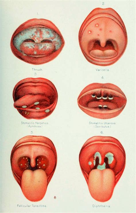 Candida Fungus Lips