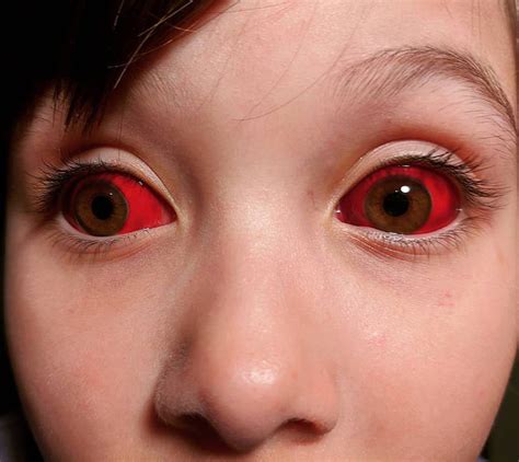 Case of a subconjunctival bleeding in an otherwise healthy child. : r ...