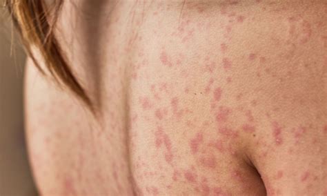 amoxicillin rash           treat