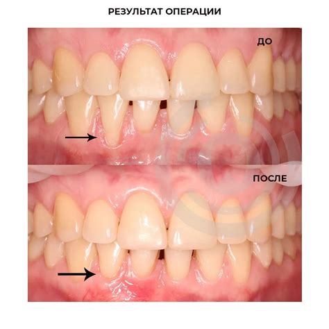 Хирургическое закрытие рецессий. Рецессия десны классификация.