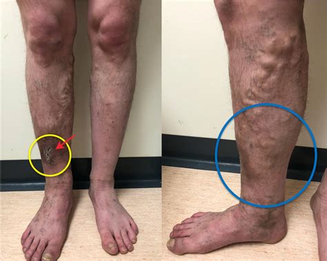 Varicose Veins Diagram St Louis Laser Veins - vrogue.co