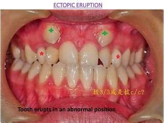 eruption  shedding clinical aspects pptx