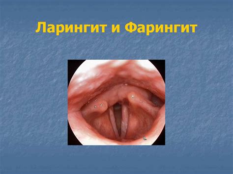 Ларингит и фарингит - презентация онлайн