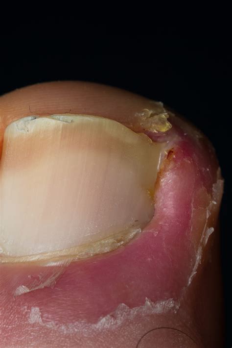 Nail Thickening (Onychauxis) at Bridget Huizenga blog