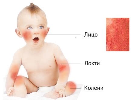 Чесотка у детей: симптомы, первые признаки, лечение, фото, лекарства ...