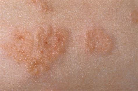 Diabetes Itchy Rash Treatment at Kelli Johnson blog