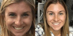 Exsynutriment Antes E Depois - Exsynutriment - Para Que Serve, Como Funciona e Efeitos Colaterais ...