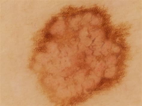 Dermoscopy Atlas | Diagnosis Detail