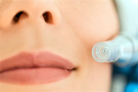 Microneedling Pen for Fuller Lips: How to Get Long-Lasting, Natural ...