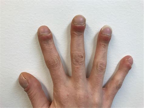 Clubbing Of The Fingers Or Toes, 53% OFF